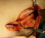 sulcus-ulnaris-syndrom-operation-10215w.jpg sulcus-ulnaris-syndrom-operation-10215w.jpg